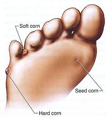 Corn on inside hot sale of 4th toe