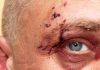 Zoomed in view of an older man with with an injury to his left eye