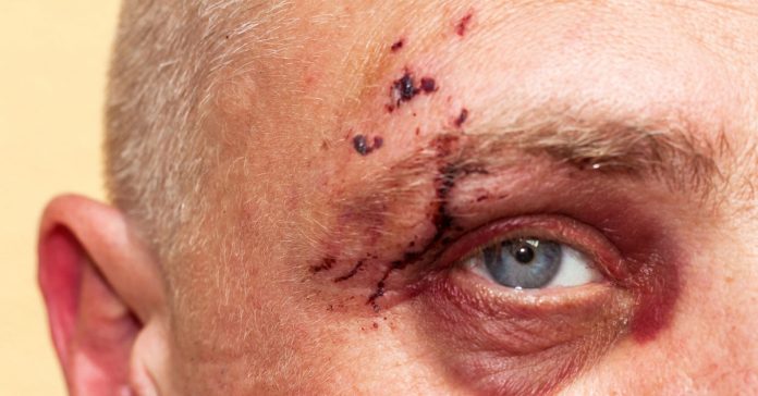 Zoomed in view of an older man with with an injury to his left eye